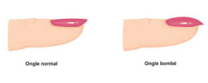 Rosecoranails- ongle plat vs ongle bombé